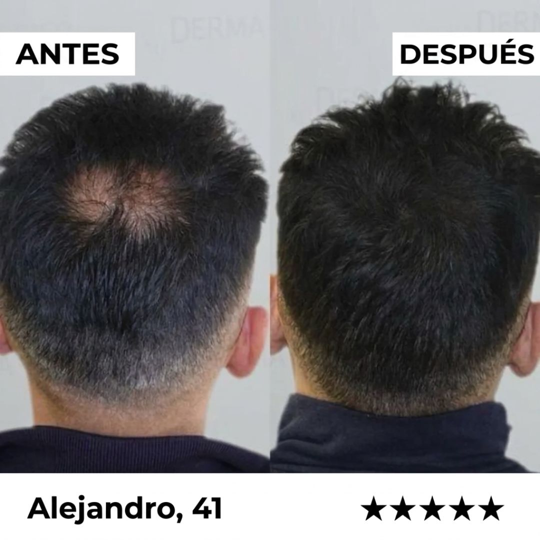 ¿Pierdes cabello cada día? Este sistema lo detiene en semanas — sin Minoxidil