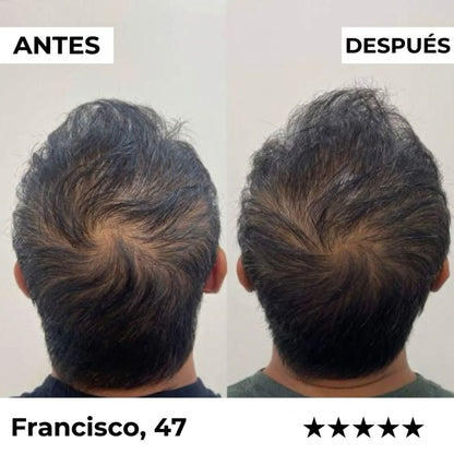 ¿Pierdes cabello cada día? Este sistema lo detiene en semanas — sin Minoxidil